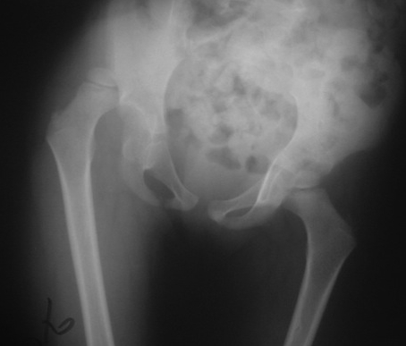 Paediatric Hip Dislocation